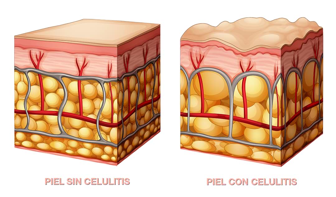 ¿Qué es la celulitis?