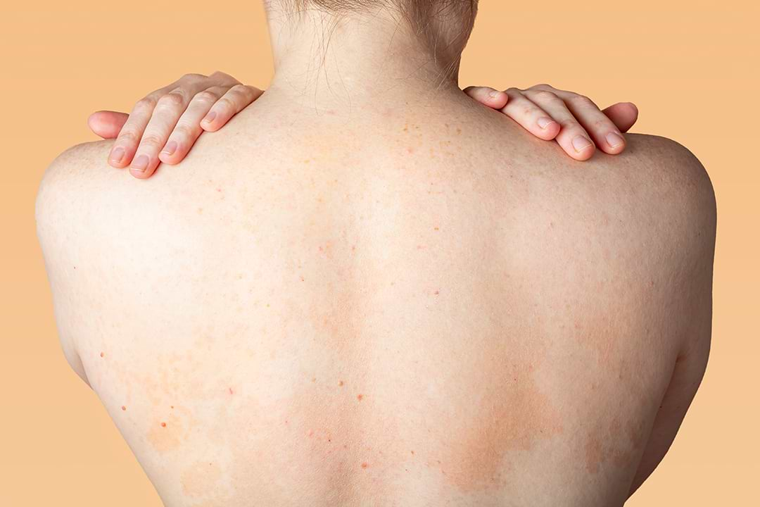 es la piel atópica o dermatitis atópica y cómo tratarla? - Nahrin